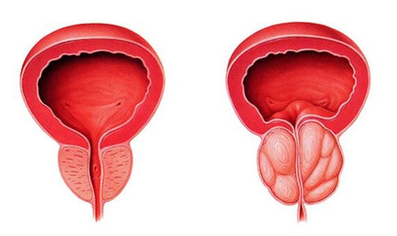 Normali ir uždegusi prostata (prostatitas)