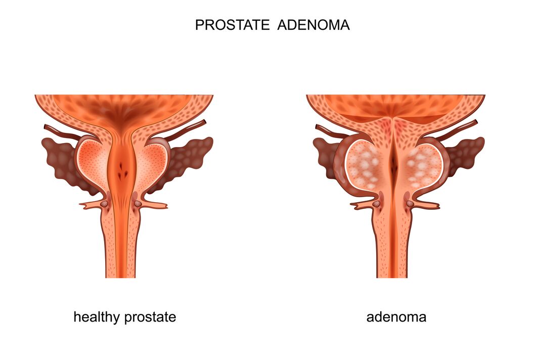 Sveika prostata ir adenoma