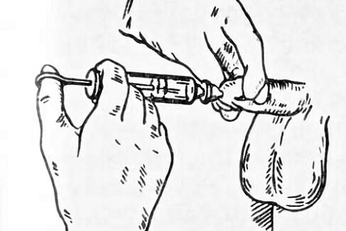 instiliacijos nuo prostatito