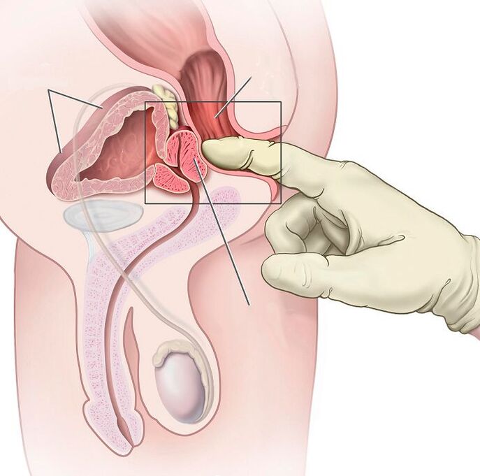 Prostatos masažas prostatito gydymui