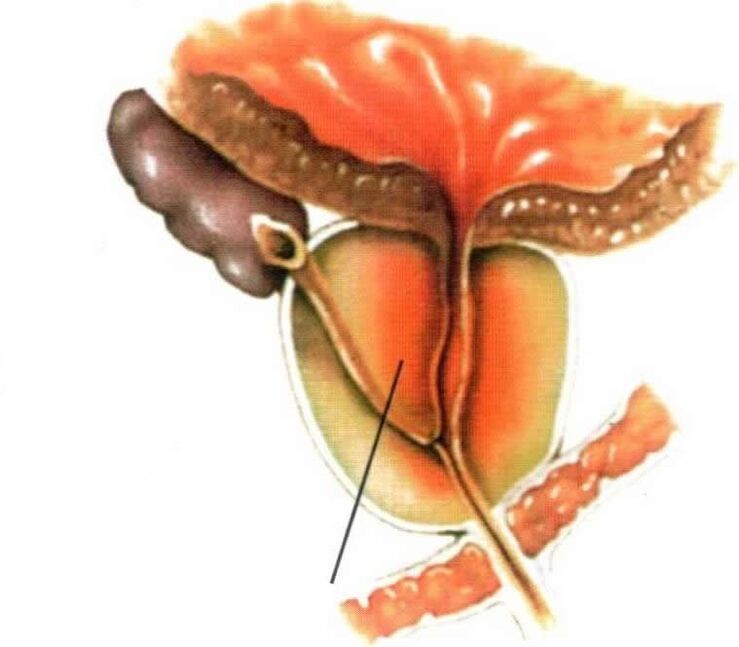 Prostatos audinio uždegimas sergant lėtiniu prostatitu
